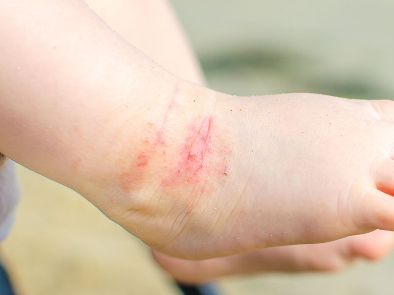 ekzem turmalin seife dermatitis akne juckreiz er anti pilz bakterien 